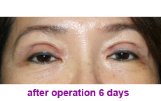 plastic-surgery-blepharoplasty